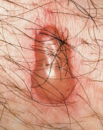 Blister on human skin from a blister beetle